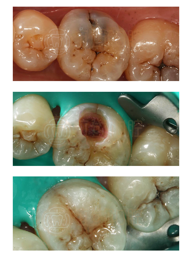 龋齿充填(补牙)案例